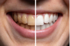 Smile before and after