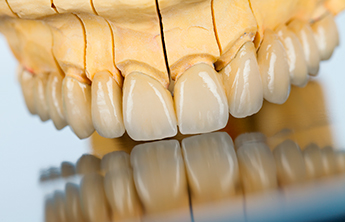 Ceramic crowns